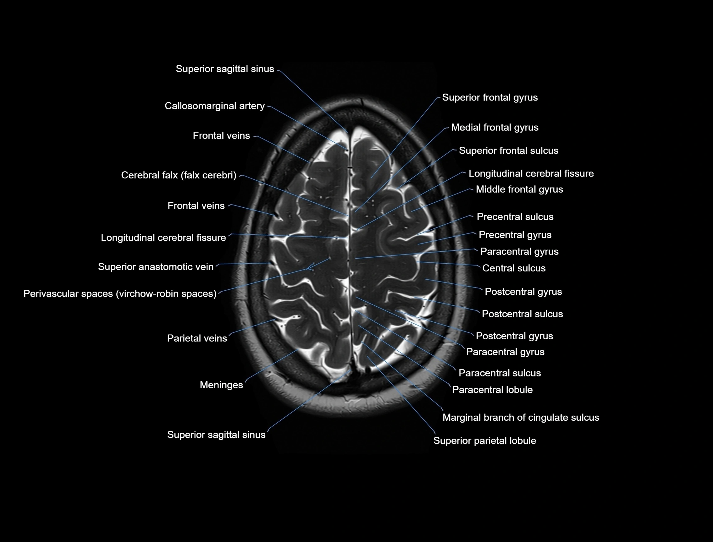 MRI Brain axial cross sectional radiology anatomy 3T image  -img-00001-00049.webp